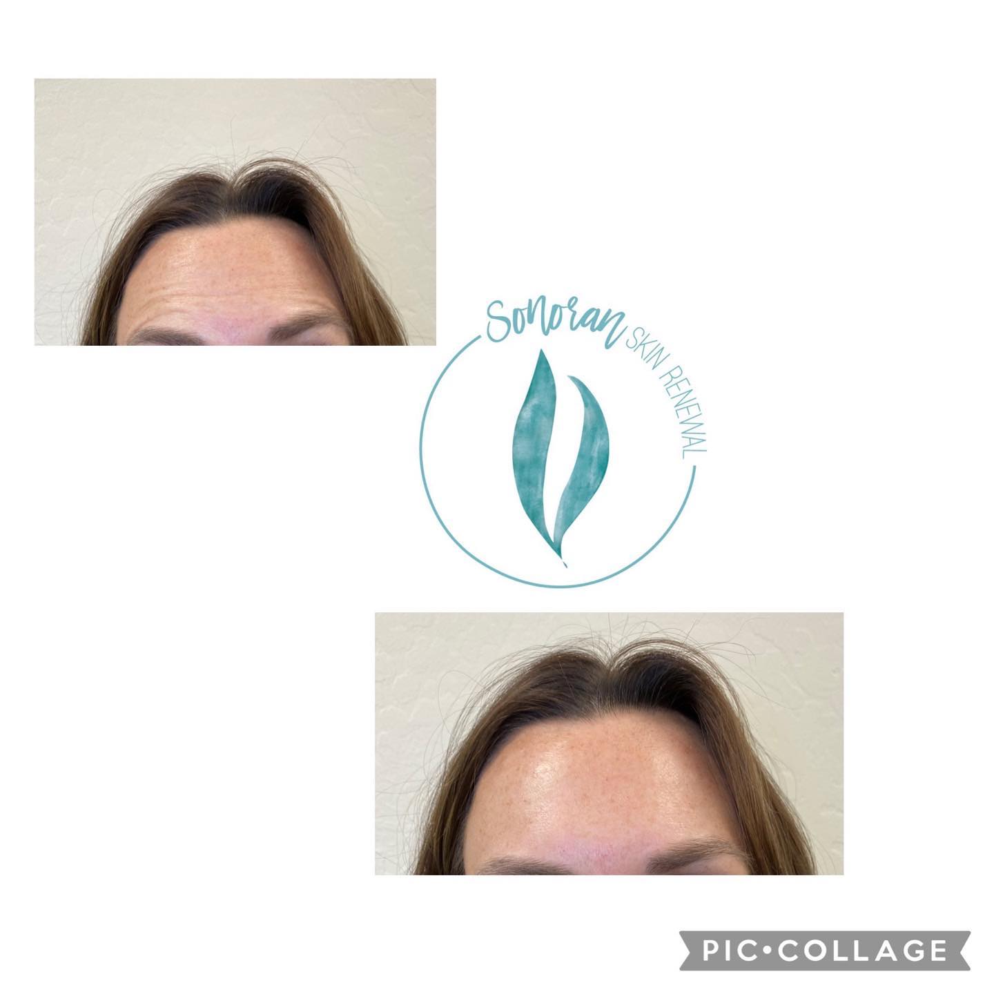 Botox before and after — softened forehead lines and frown lines — Sonoran Skin Renewal, Scottsdale AZ