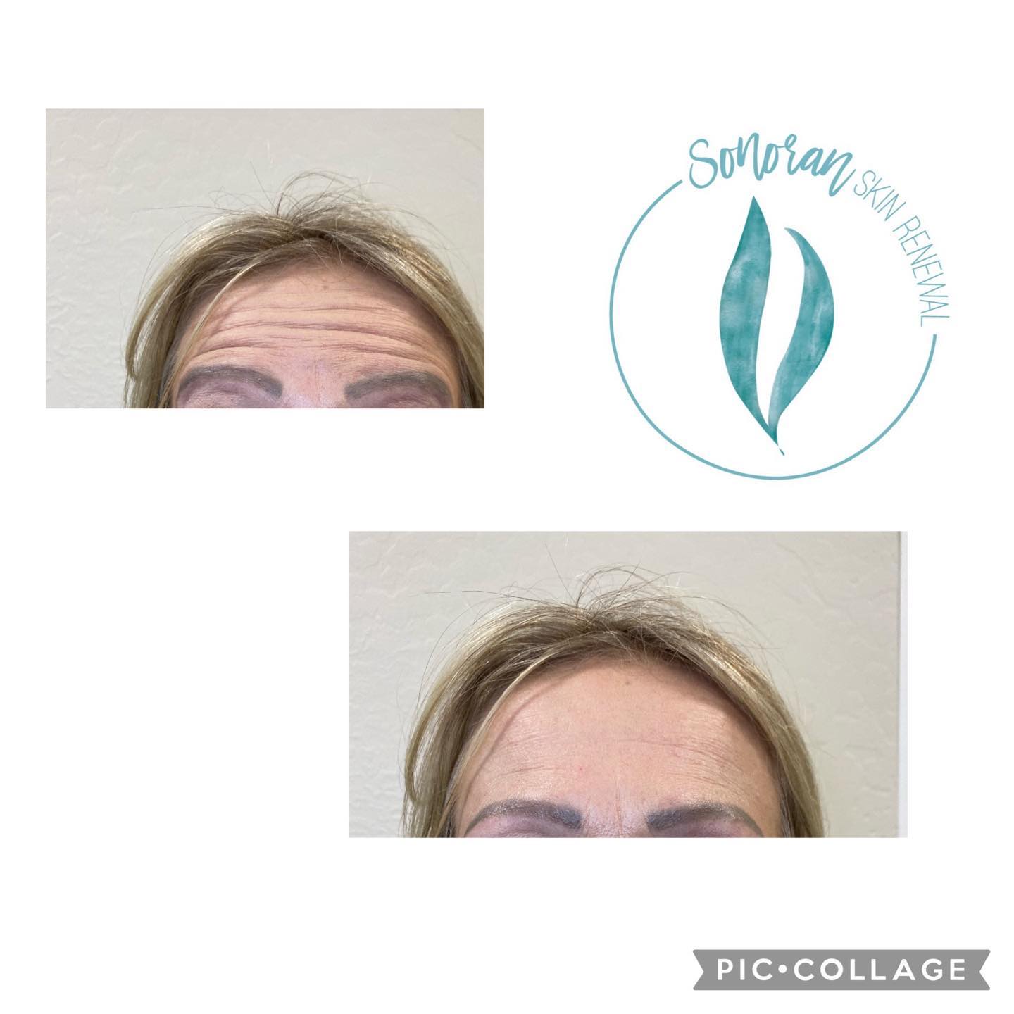 Botox before and after — softened forehead lines and frown lines — Sonoran Skin Renewal, Scottsdale AZ