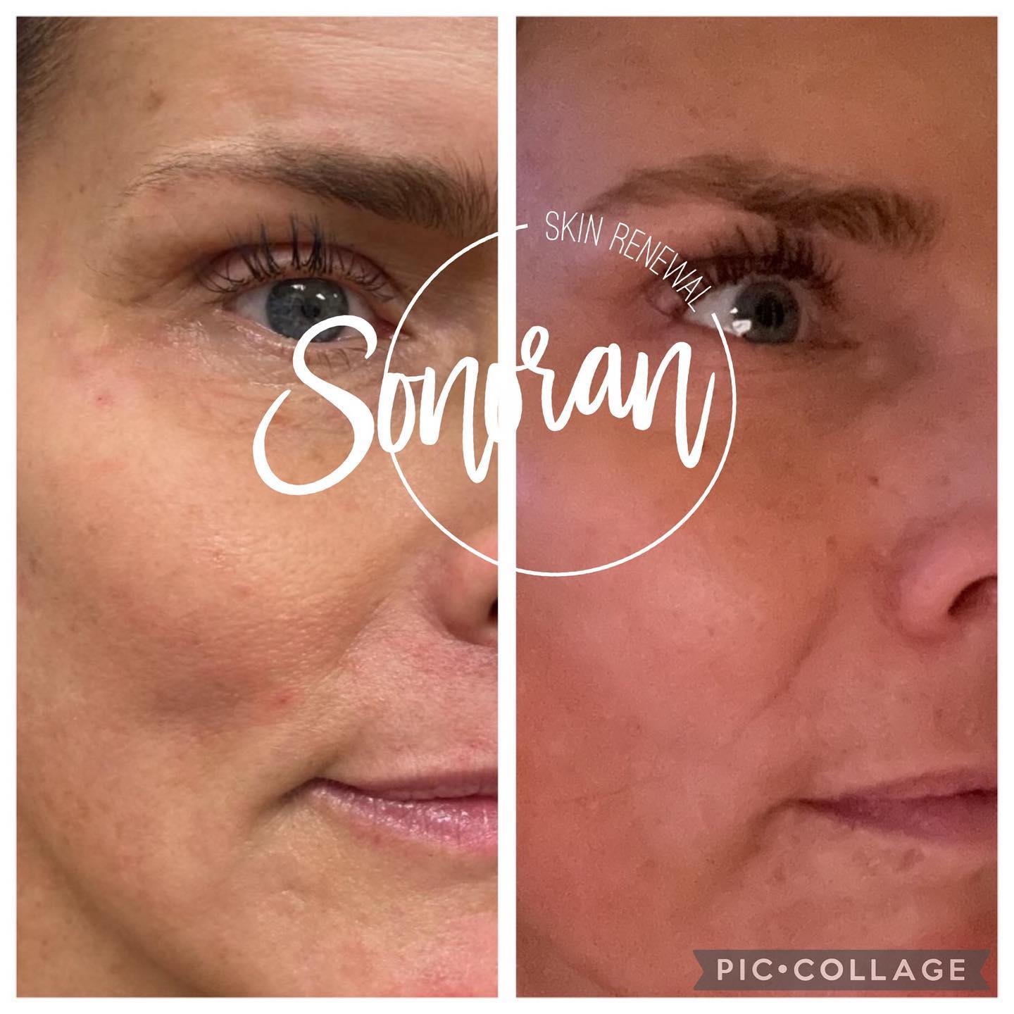 Dermal filler before and after — restored midface volume and structure — Sonoran Skin Renewal, Scottsdale AZ