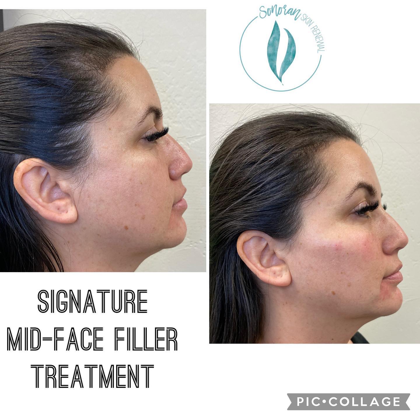 Dermal filler before and after — restored midface volume and structure — Sonoran Skin Renewal, Scottsdale AZ