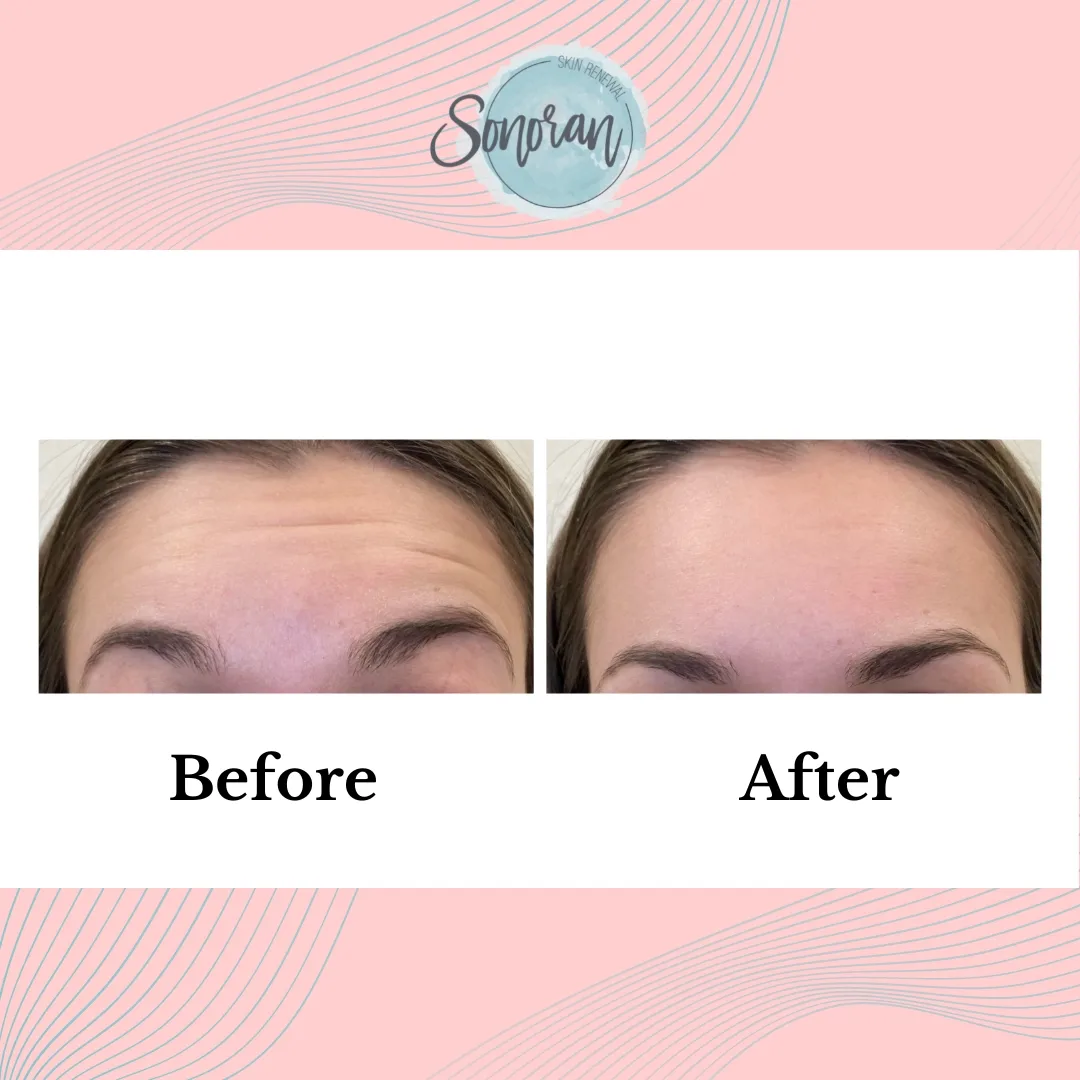 Full facial rejuvenation before and after — restored volume and smoother skin — Sonoran Skin Renewal, Scottsdale AZ