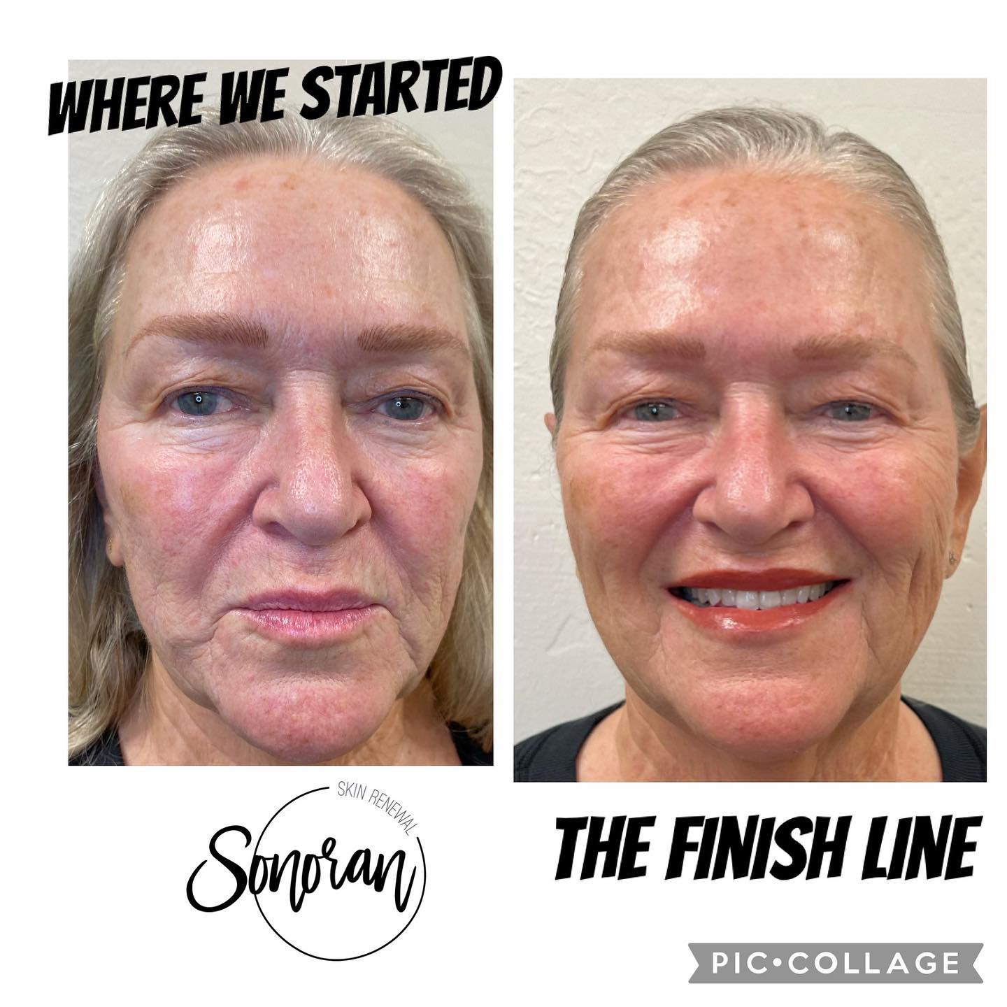 Full facial rejuvenation before and after — restored volume and smoother skin — Sonoran Skin Renewal, Scottsdale AZ