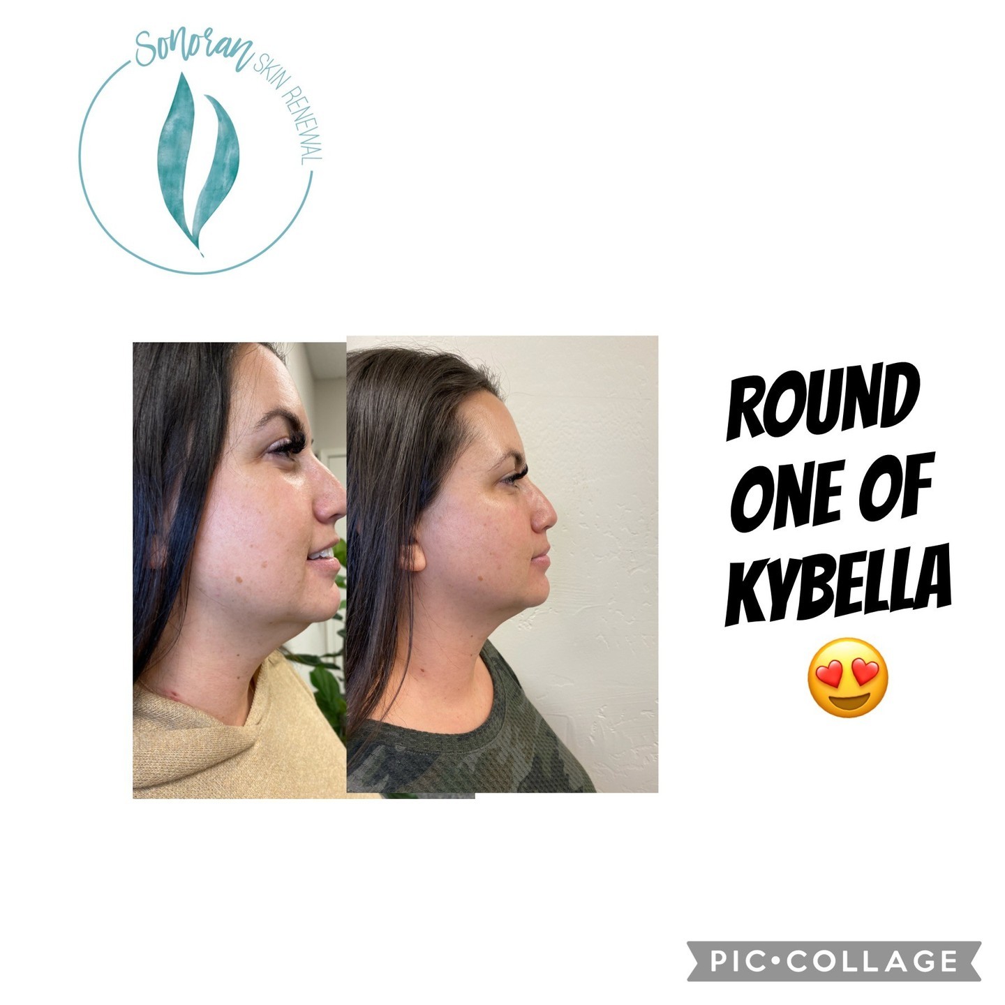 Kybella before and after — reduced submental fullness, sharper jawline — Sonoran Skin Renewal, Scottsdale AZ