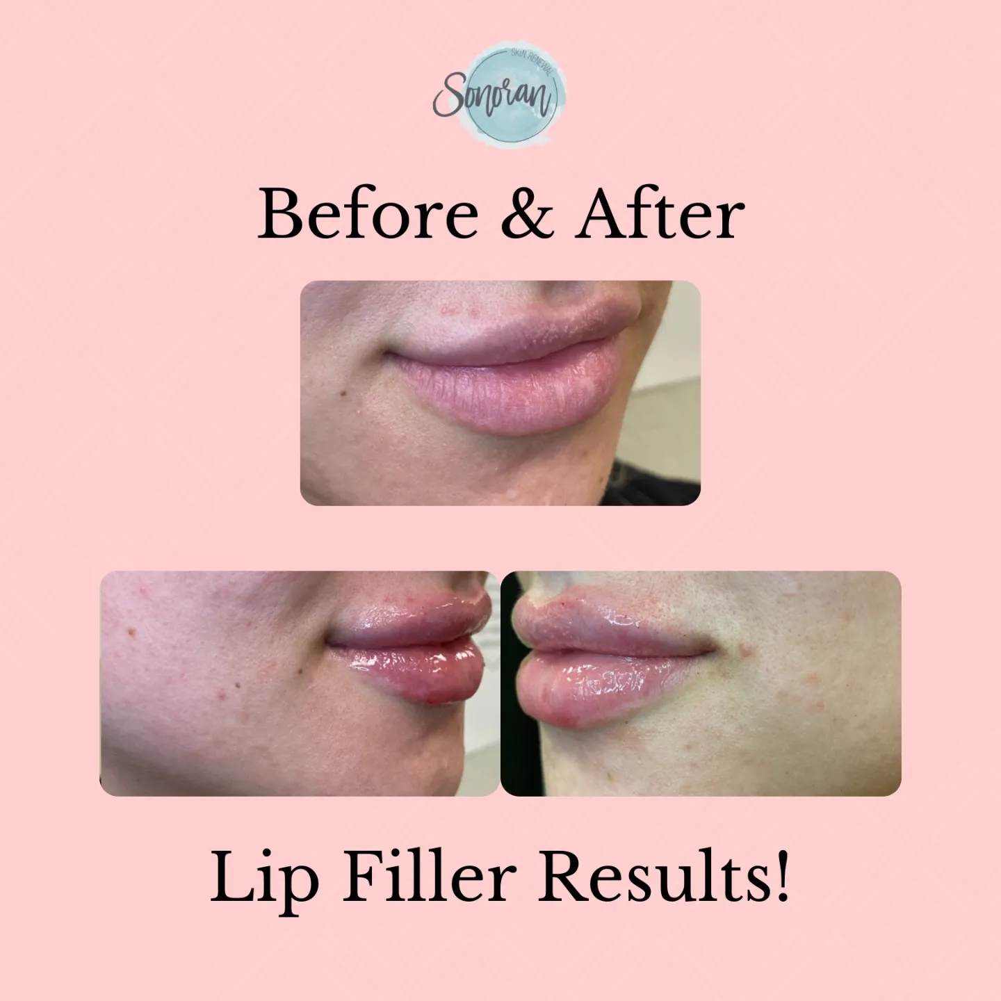 Lip filler before and after — added volume, definition and hydration — Sonoran Skin Renewal, Scottsdale AZ
