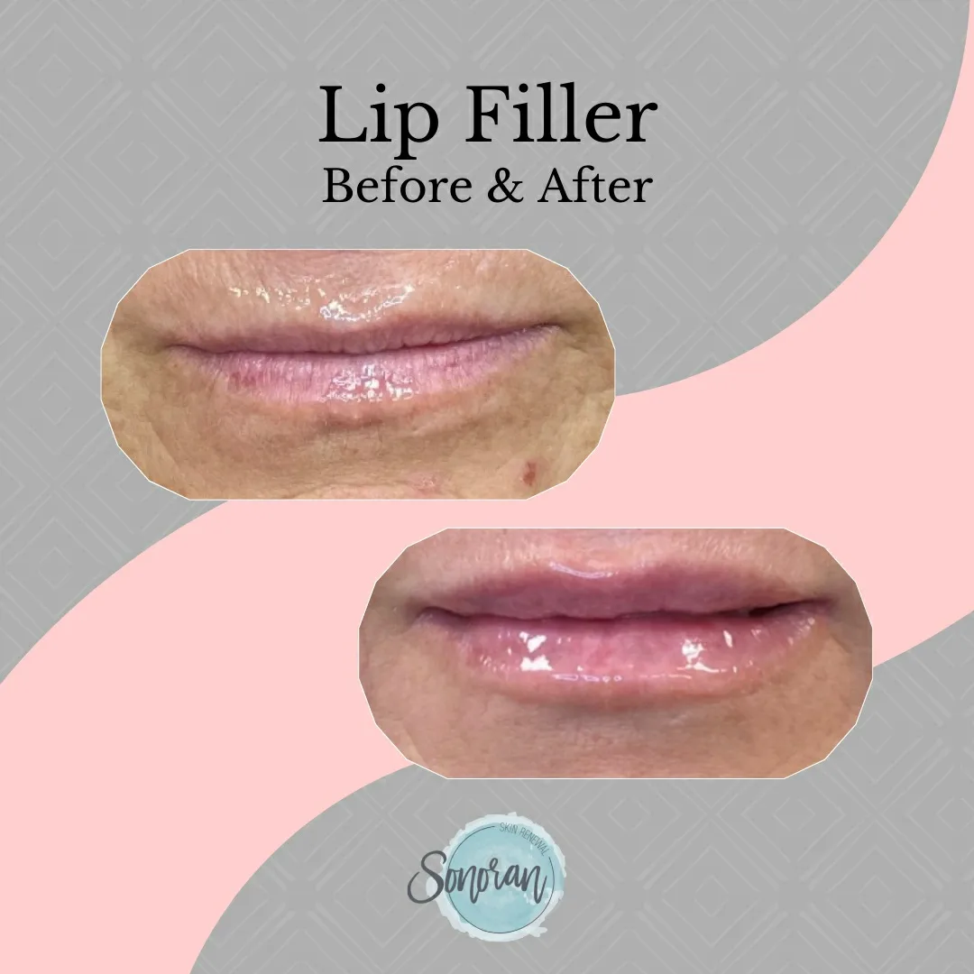 Lip filler before and after — added volume, definition and hydration — Sonoran Skin Renewal, Scottsdale AZ