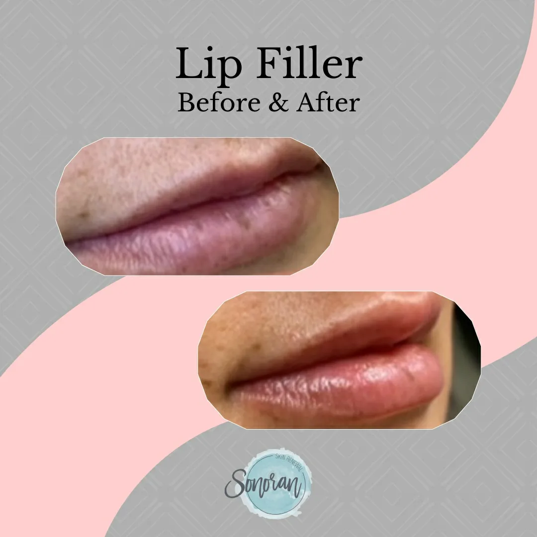 Lip filler before and after — added volume, definition and hydration — Sonoran Skin Renewal, Scottsdale AZ