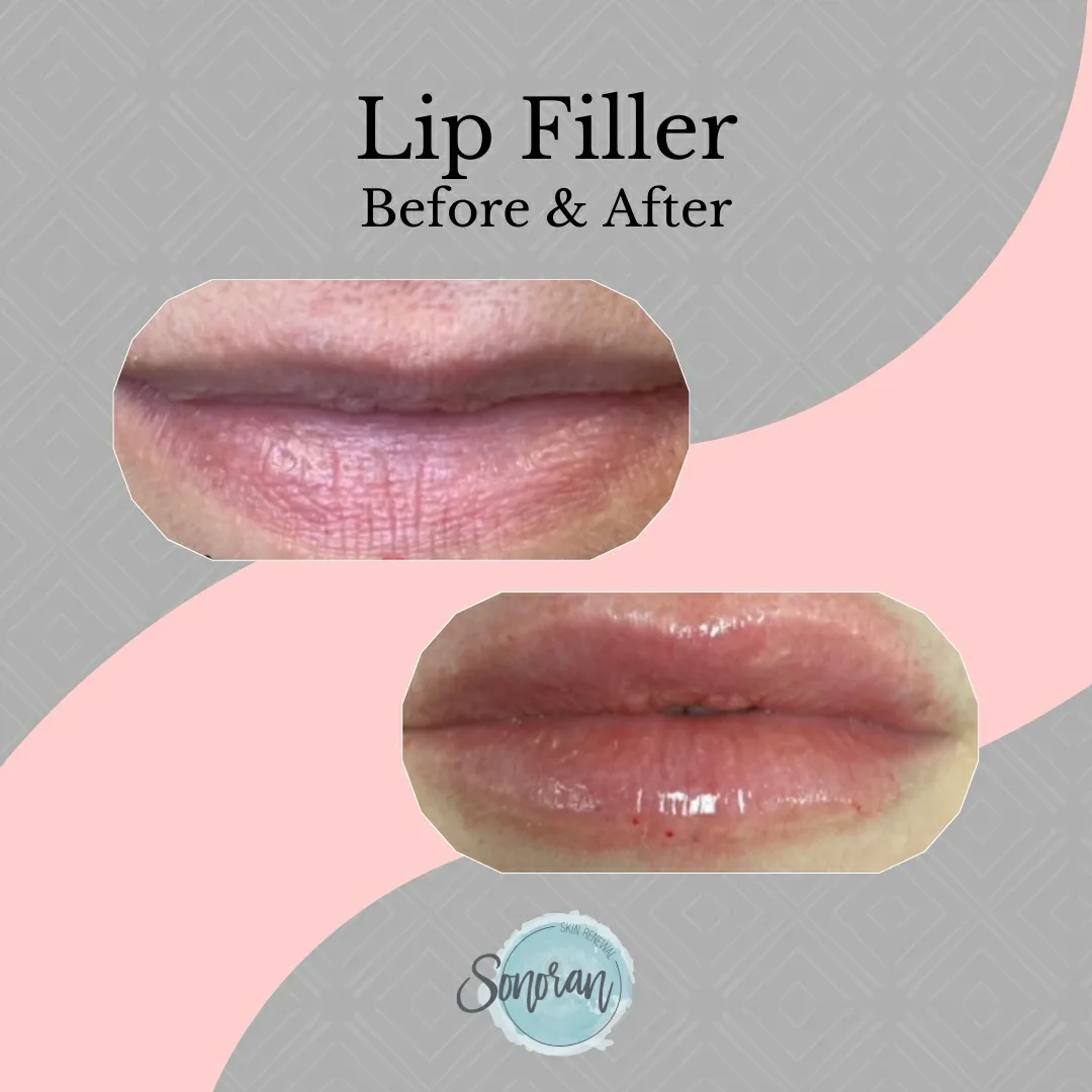 Lip filler before and after — added volume, definition and hydration — Sonoran Skin Renewal, Scottsdale AZ