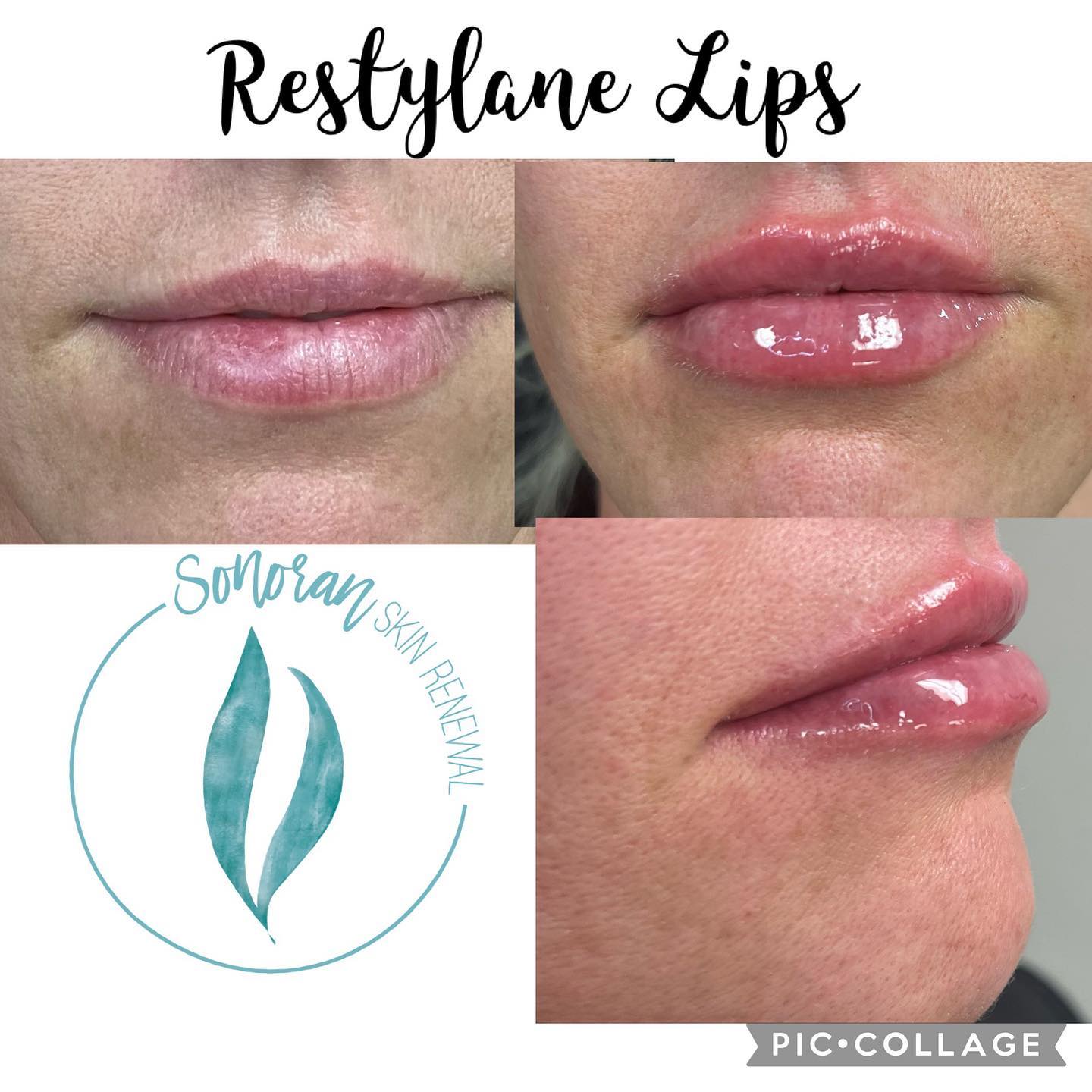 Lip filler before and after — added volume, definition and hydration — Sonoran Skin Renewal, Scottsdale AZ