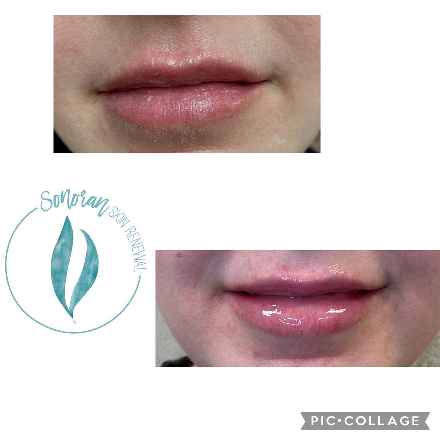 Lip filler before and after — added volume, definition and hydration — Sonoran Skin Renewal, Scottsdale AZ