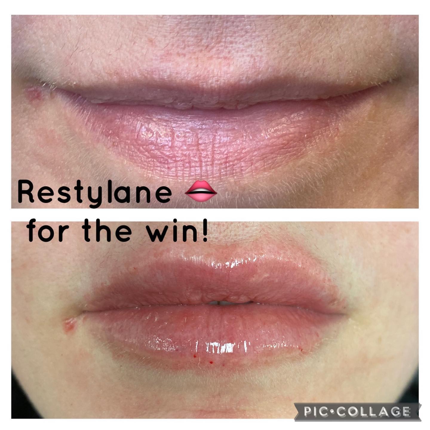 Lip filler before and after — added volume, definition and hydration — Sonoran Skin Renewal, Scottsdale AZ
