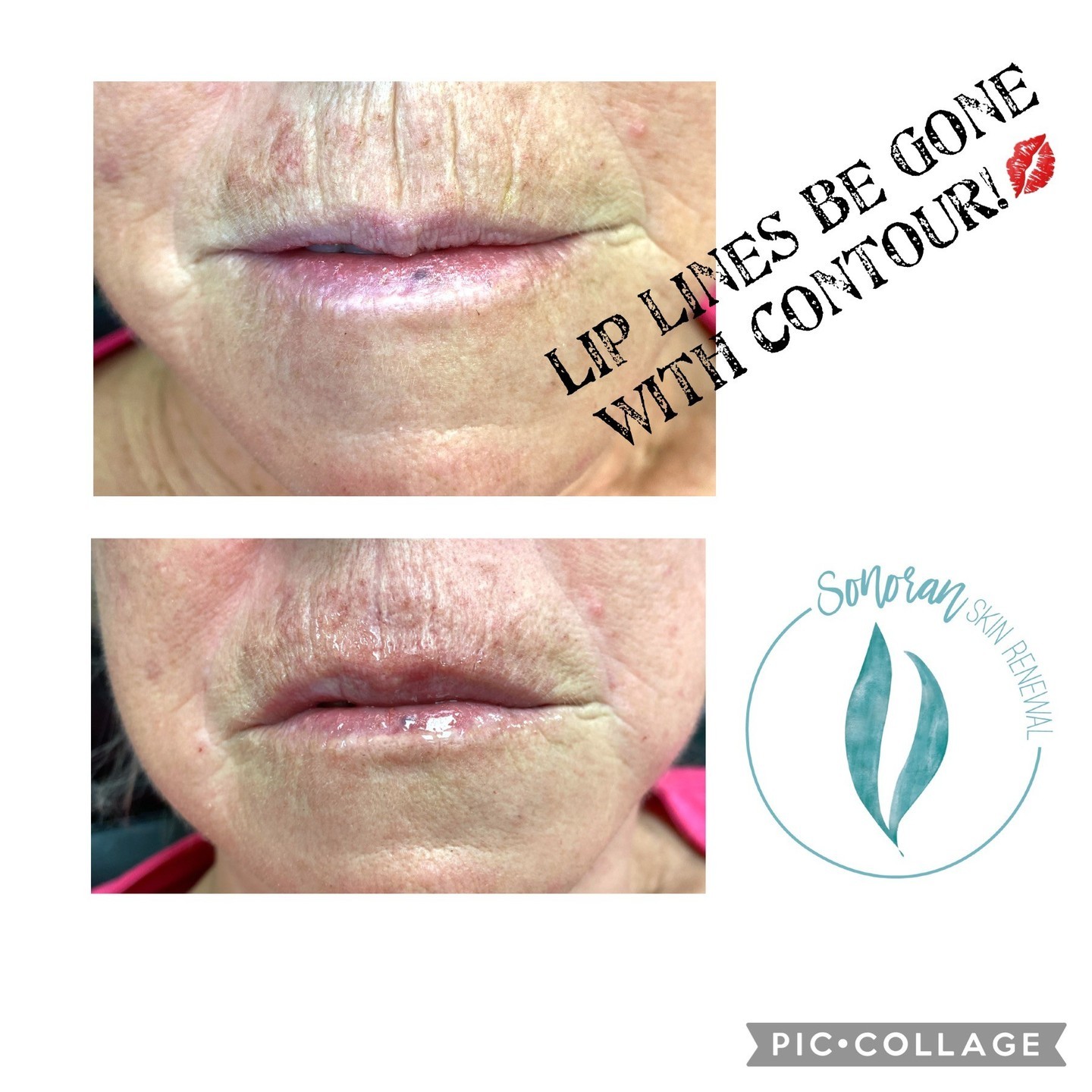 Lip filler before and after — added volume, definition and hydration — Sonoran Skin Renewal, Scottsdale AZ