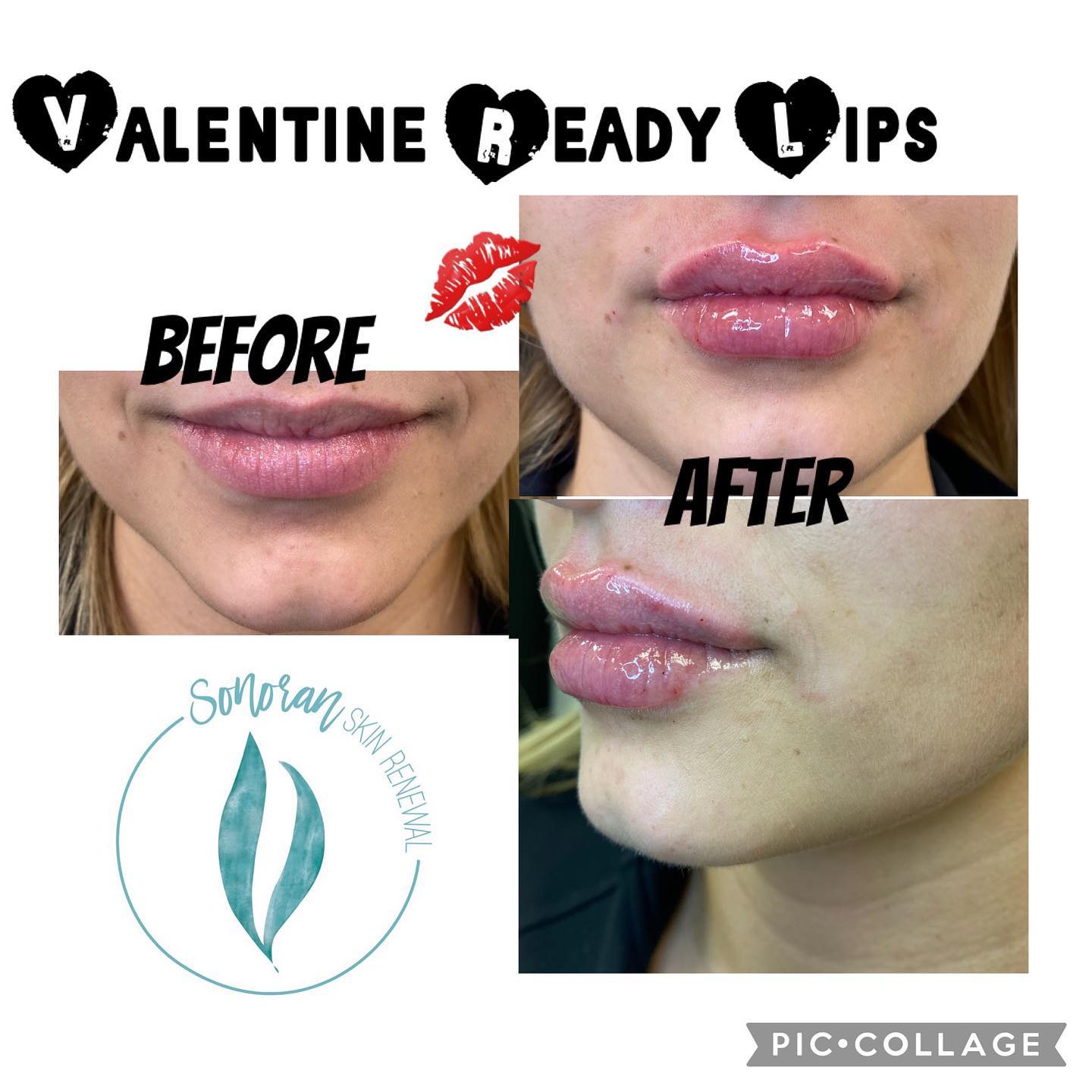 Lip filler before and after — added volume, definition and hydration — Sonoran Skin Renewal, Scottsdale AZ