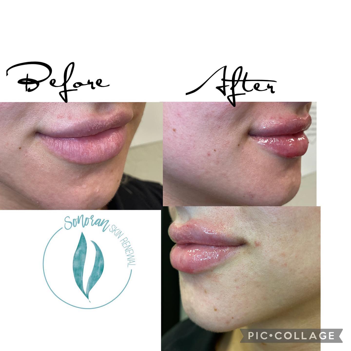 Lip filler before and after — added volume, definition and hydration — Sonoran Skin Renewal, Scottsdale AZ