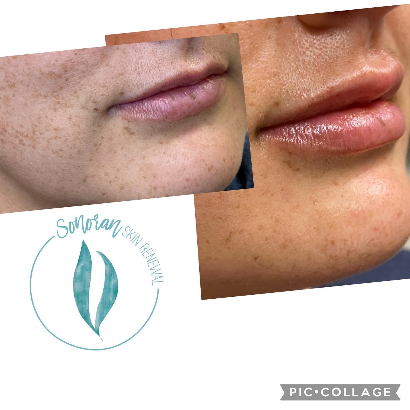 Lip filler before and after — added volume, definition and hydration — Sonoran Skin Renewal, Scottsdale AZ