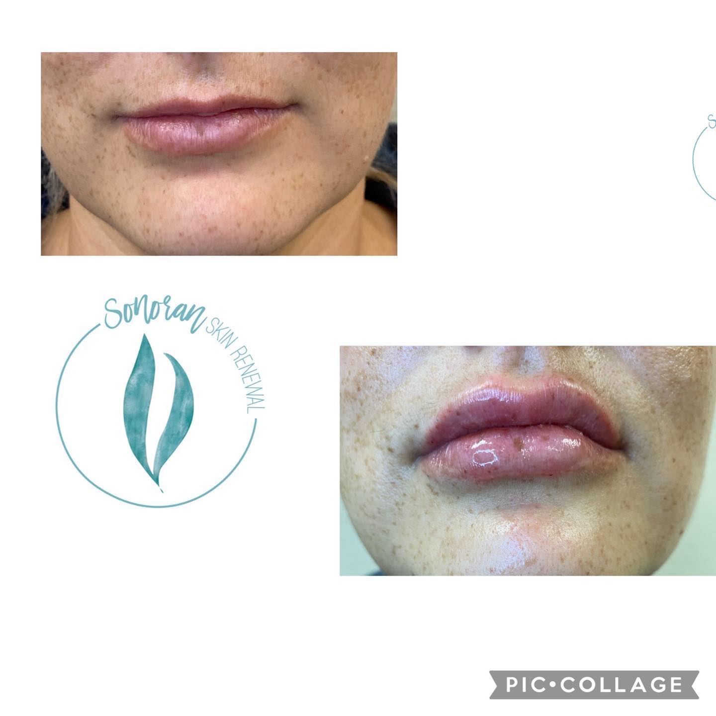 Lip filler before and after — added volume, definition and hydration — Sonoran Skin Renewal, Scottsdale AZ