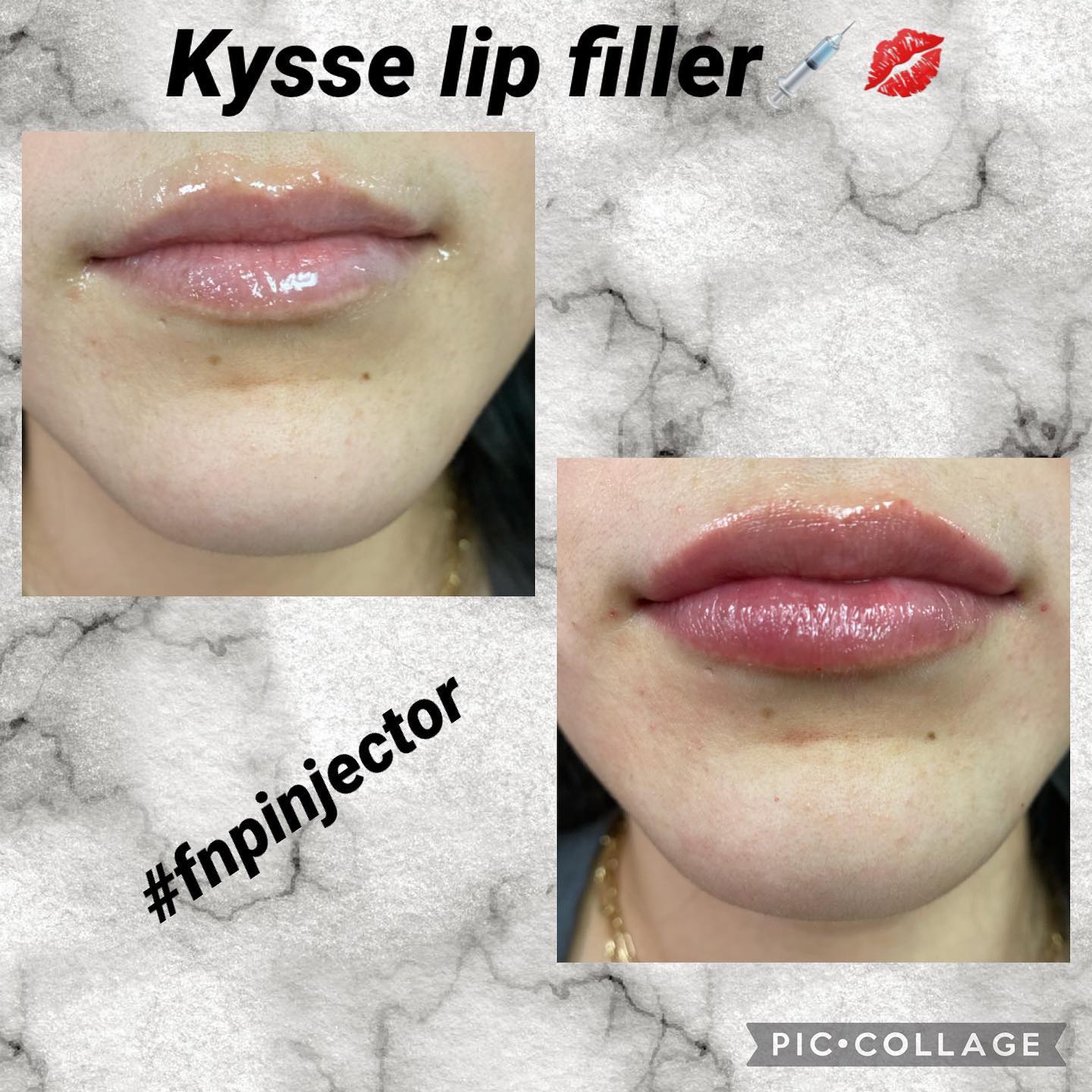 Lip filler before and after — added volume, definition and hydration — Sonoran Skin Renewal, Scottsdale AZ