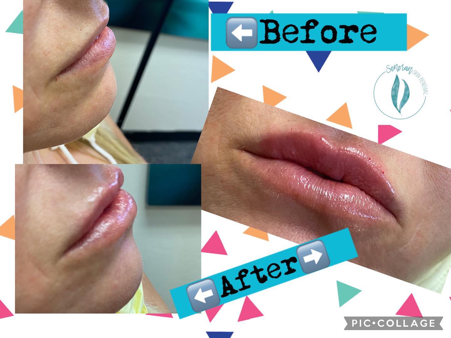 Lip filler before and after — added volume, definition and hydration — Sonoran Skin Renewal, Scottsdale AZ