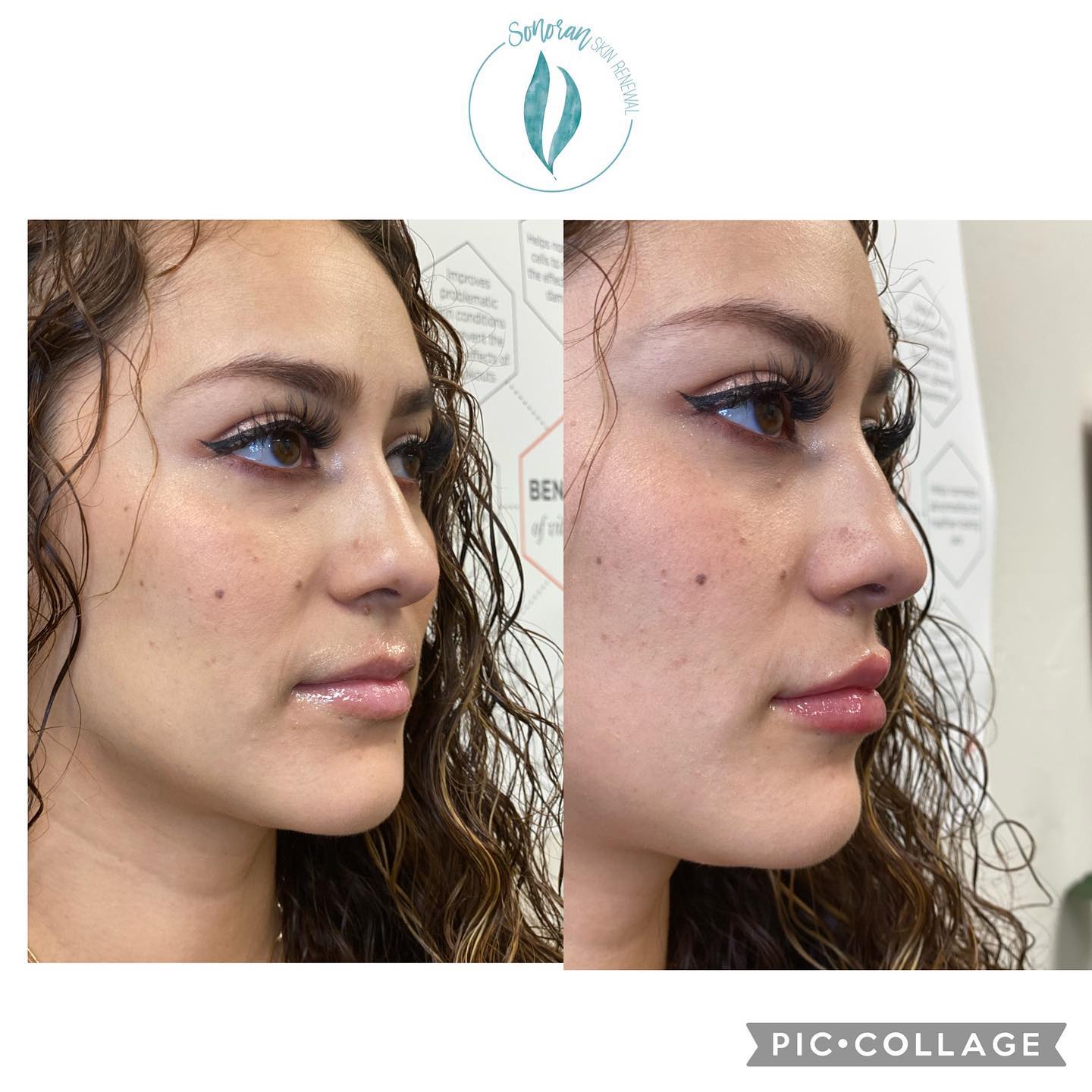 Lip filler before and after — added volume, definition and hydration — Sonoran Skin Renewal, Scottsdale AZ