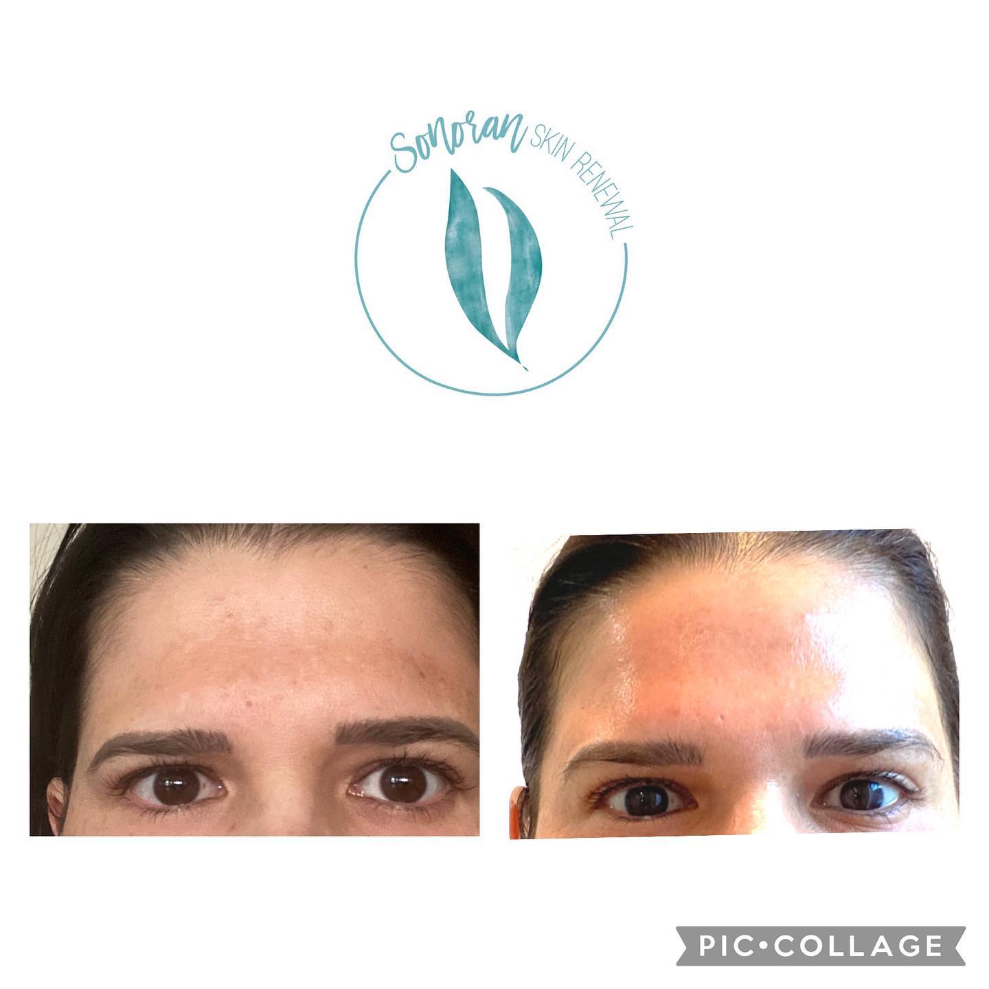 Medical-grade skincare before and after — clearer, brighter, more even skin — Sonoran Skin Renewal, Scottsdale AZ