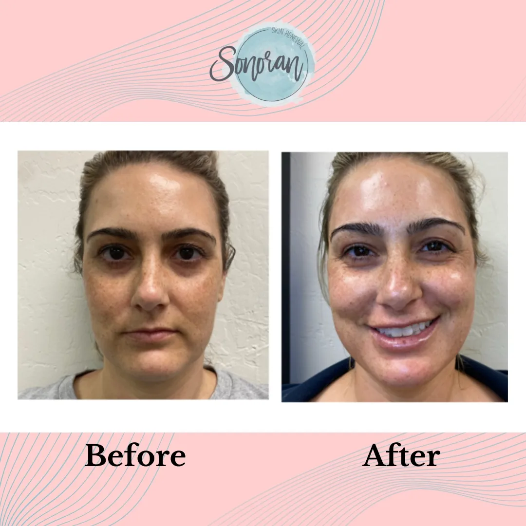 Microneedling before and after — refined texture and clearer skin — Sonoran Skin Renewal, Scottsdale AZ