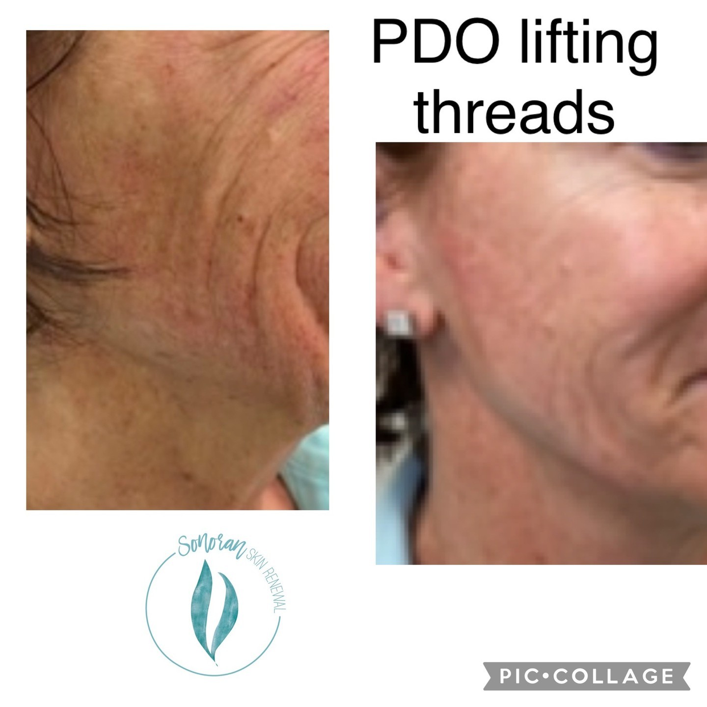 PDO thread lift before and after — lifted, tightened contour — Sonoran Skin Renewal, Scottsdale AZ