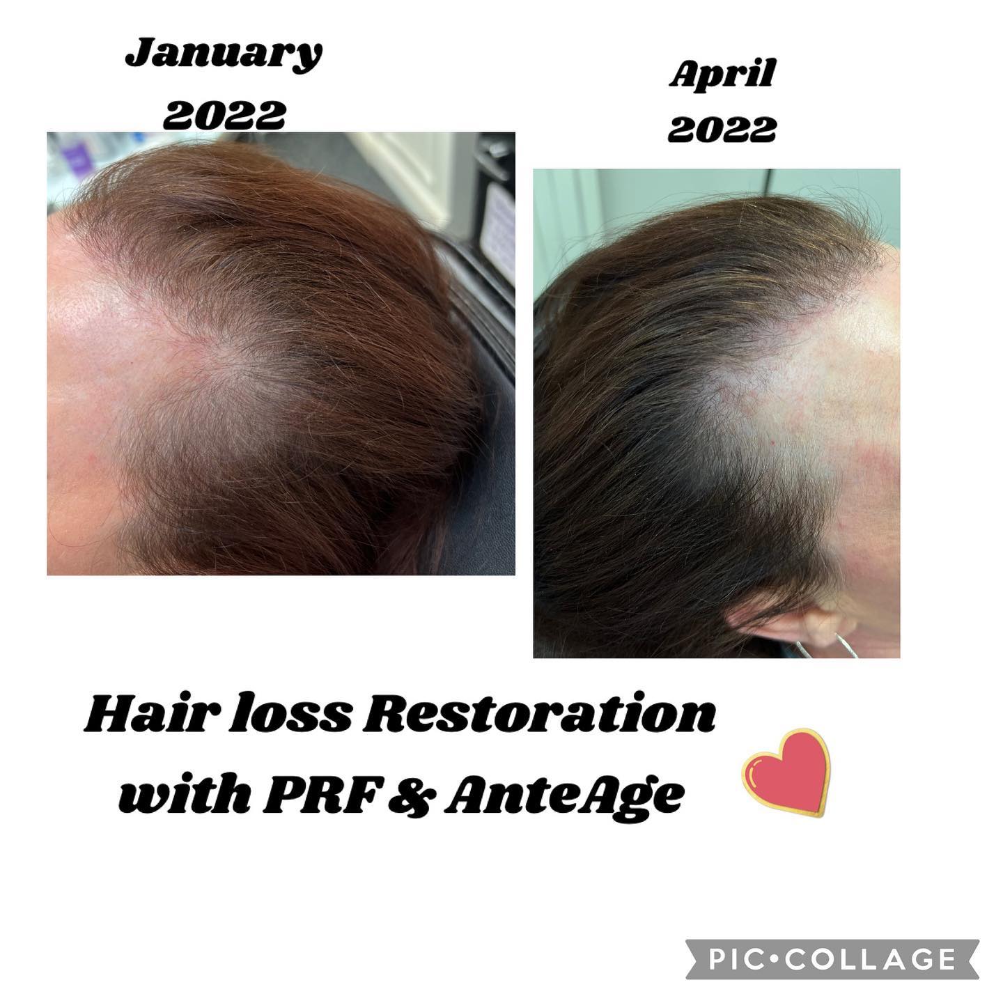 PRF hair restoration before and after — denser, thicker regrowth — Sonoran Skin Renewal, Scottsdale AZ