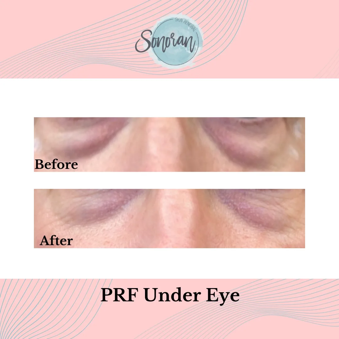 PRF under-eye before and after — brighter, fuller under-eye area — Sonoran Skin Renewal, Scottsdale AZ