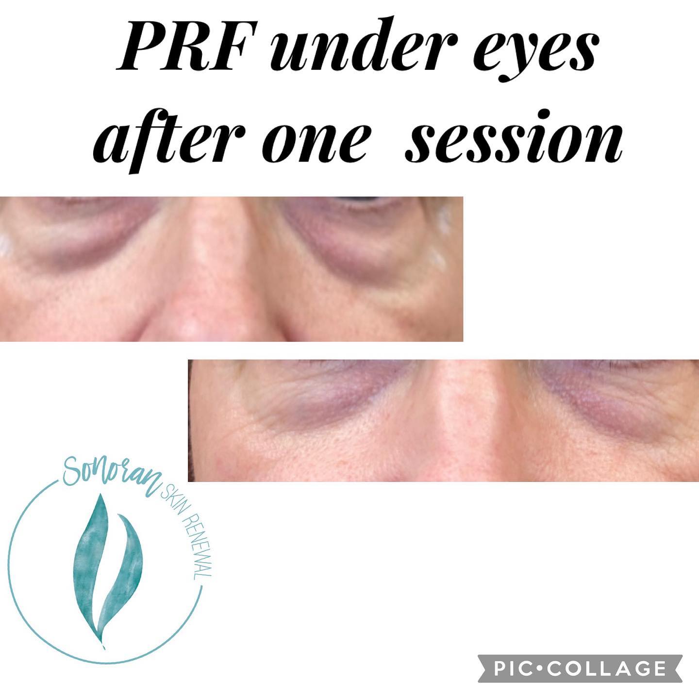 PRF under-eye before and after — brighter, fuller under-eye area — Sonoran Skin Renewal, Scottsdale AZ